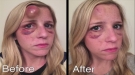 This Woman's Goose Egg Was So Big That Doctors Were Forced To Pop It